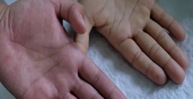 Çok az görülüyor! Milyon nüfusta 2 yahut 4 bireyde rastlanıyor…