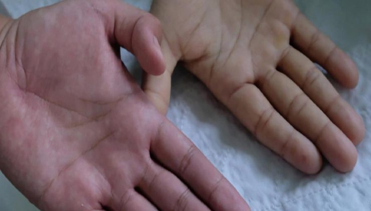 Çok az görülüyor! Milyon nüfusta 2 yahut 4 bireyde rastlanıyor…